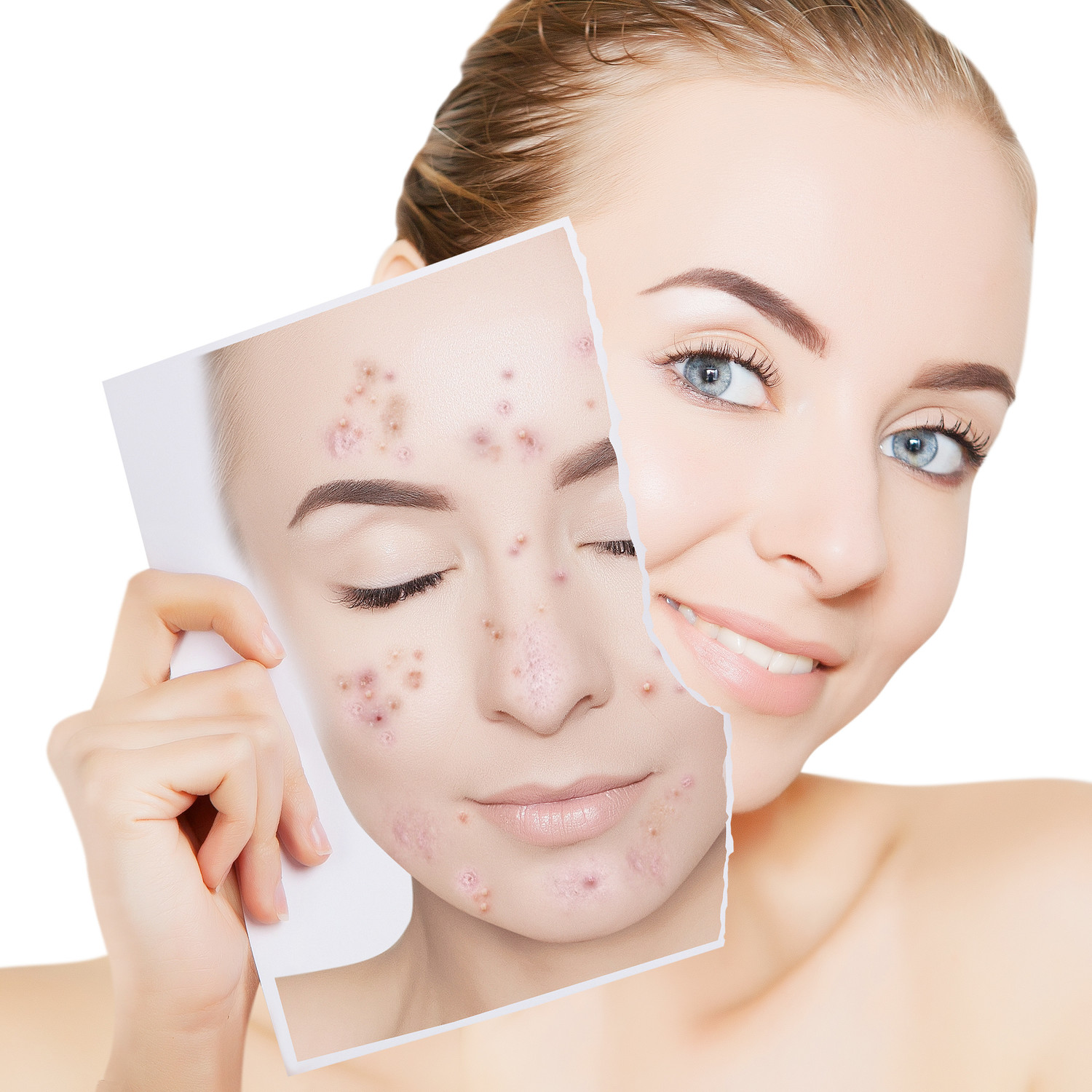 Dermatologisches Fruchtsäurepeeling